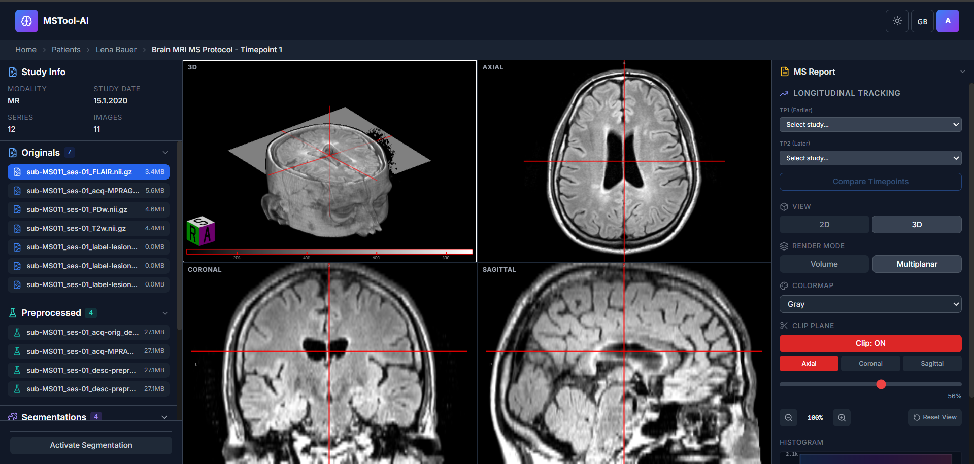 MSTool-AI — AI-assisted MRI analysis for multiple sclerosis